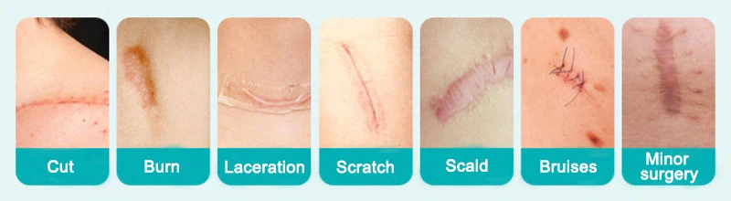 Allantoin Repair Scars Allantoin Repair Scars
